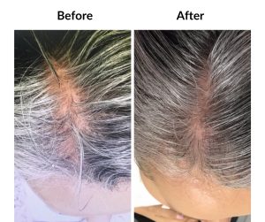 BEFORE AFTER - Female - Bald&Thinning