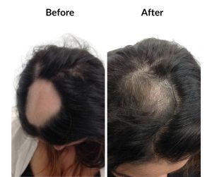 BEFORE AFTER - Female - Balding