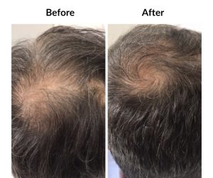 BEFORE AFTER - Male - Bald&Thinning