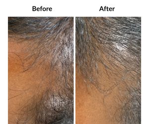 BEFORE AFTER - Male - Thinning and balding, same guy