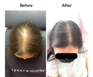 BEFORE AFTER - Female - Thinning 2