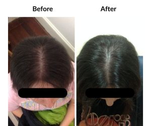 BEFORE AFTER - Female - Thinning