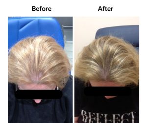 BEFORE AFTER - Female - Thinning 4