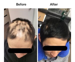 BEFORE AFTER - Male - 3 Balding