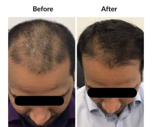 BEFORE AFTER - Male - Thinning and balding, same guy, 2 (2)